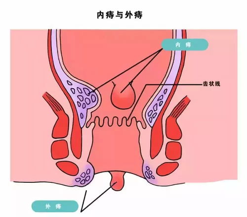 痔瘡手術(shù)后應(yīng)注意事項