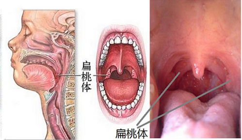 扁桃體摘除手術(shù)后注意什么,腺樣體和扁桃體摘除手術(shù)后的注意事項(xiàng),扁桃體摘除手術(shù)術(shù)后注意事項(xiàng)