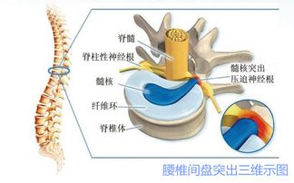 腰椎間盤(pán)突出癥患者注意事項(xiàng)有哪些呢?,腰椎間盤(pán)突出癥的注意事項(xiàng),腰椎間盤(pán)突出癥出院注意事項(xiàng)