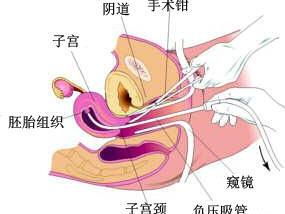 引產(chǎn)手術(shù)術(shù)前注意事項(xiàng),引產(chǎn)手術(shù)后需要注意事項(xiàng),引產(chǎn)注意事項(xiàng)大全