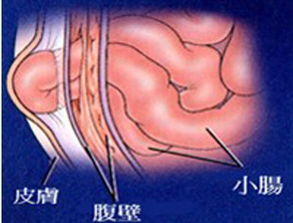 疝氣手術的注意事項