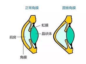 圓錐角膜術(shù)后注意事項,圓錐角膜平時注意事項,圓錐角膜配鏡注意事項