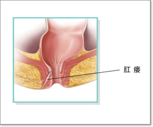 艾滋病可以做肛瘺手術(shù)嗎,艾滋病肛瘺去哪里手術(shù),艾滋病肛瘺手術(shù)多久恢復(fù)