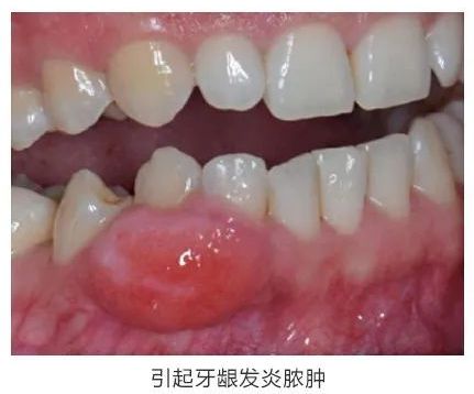 補(bǔ)牙后有什么注意事項(xiàng)