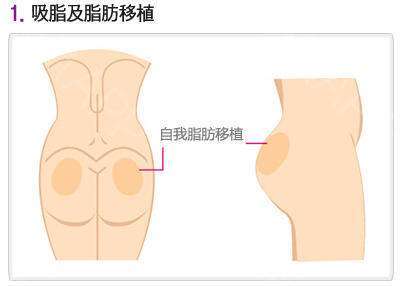屁股粉瘤手術后注意事項,屁股腫物手術后注意事項,屁股激光手術后注意事項