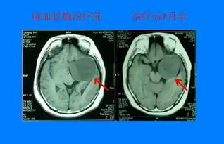 腦血管瘤注意事項(xiàng)