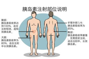 寫(xiě)出胰島素注射的注意事項(xiàng)