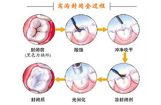 牙齒做封閉后注意事項(xiàng),牙齒根管治療后注意事項(xiàng),洗完牙齒后的注意事項(xiàng)