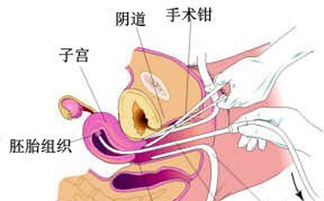 無痛打胎的注意事項(xiàng),無痛微創(chuàng)包莖手術(shù)注意事項(xiàng),無痛微創(chuàng)人流后注意事項(xiàng)