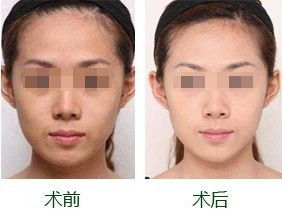 激光點痣注意事項,點陣激光后注意事項,尋常疣激光后注意事項