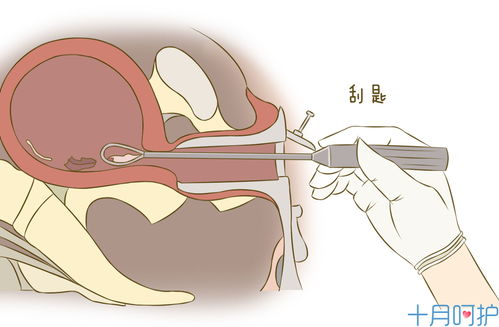 刮宮,產(chǎn)后,注意事項(xiàng)