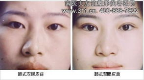 韓式微創(chuàng)雙眼皮術(shù)后注意事項(xiàng),韓式雙眼皮術(shù)后注意事項(xiàng)有哪些,雙眼皮術(shù)后注意事項(xiàng)及護(hù)理