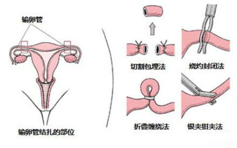 結(jié)扎復(fù)通術(shù)后要注意什么,輸精管結(jié)扎術(shù)后注意事項(xiàng),精索靜脈曲張結(jié)扎術(shù)后注意事項(xiàng)