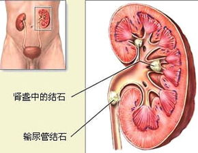 腎結(jié)石注意事項及飲食禁忌,腎結(jié)石日常生活注意事項,腎結(jié)石術(shù)后注意事項