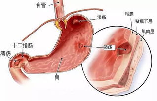 說明書中注明注意事項胃潰瘍