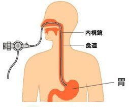 腸鏡胃鏡檢查后飲食注意事項(xiàng),無(wú)痛胃鏡檢查后飲食注意事項(xiàng)有哪些方面,胃鏡檢查后飲食需要注意事項(xiàng)