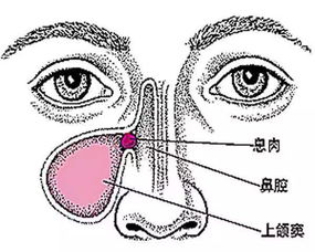 單側(cè)鼻息肉注意事項