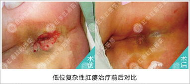 艾滋病做肛瘺手術(shù)后注意事項(xiàng)