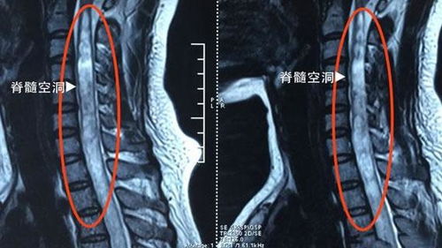 造影,脊髓,術(shù)后,注意事項(xiàng)