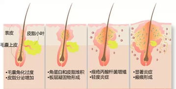 痤瘡性皮膚注意事項(xiàng)