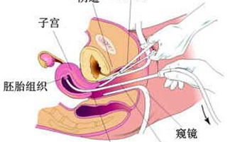 微創(chuàng)無痛打胎注意事項(xiàng)