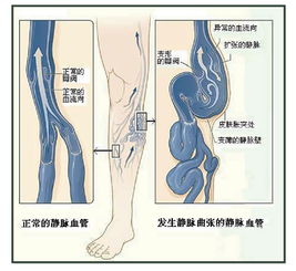 靜脈,闡述,注意事項(xiàng)