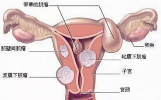 子宮肌瘤患者月經(jīng)期注意什么,子宮肌瘤患者日常注意事項(xiàng),子宮肌瘤患者性生活注意事項(xiàng)