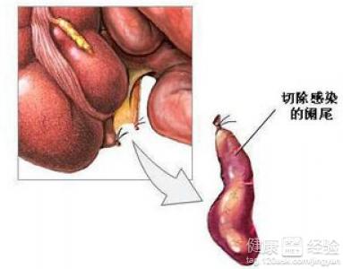 闌尾炎切除后飲食注意事項(xiàng)