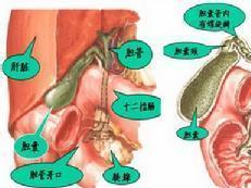 結(jié)石術(shù)后飲食注意事項,膽道鏡術(shù)后注意事項,膽道結(jié)石飲食注意事項