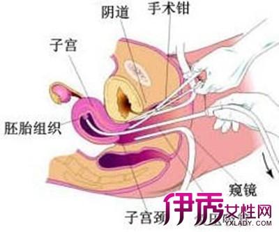 無(wú)痛刮宮之后注意事項(xiàng)