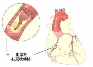 心血管,支架,注意事項(xiàng)