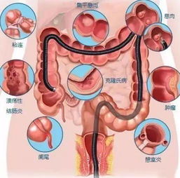 腸鏡檢查準(zhǔn)備注意事項