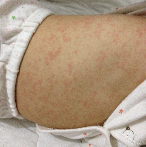 小兒出疹子應(yīng)該注意什么,小兒發(fā)燒出疹子的注意事項(xiàng),小兒退燒出疹子注意事項(xiàng)
