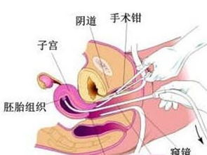 做完刮宮術(shù)后注意事項(xiàng)