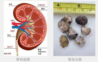 腎結(jié)石注意事項(xiàng)及飲食