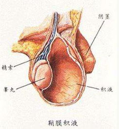 睪丸鞘膜翻轉術注意事項,睪丸鞘膜翻轉術術中注意事項,鞘膜積液翻轉術后注意事項