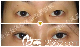 做雙眼皮前后注意事項(xiàng)