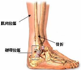 腳踝,應(yīng)注意,骨折,事項