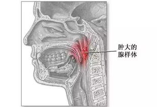 小兒腺樣體肥大的基礎(chǔ)知識